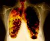 I'm at it again-050813_lung_hsmall.widec.jpg