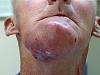 I'm at it again-20050817-oral-cancer-2.jpg